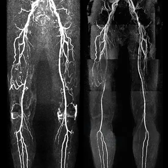 mr angiography left lower limb with contrast